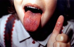 virus pieds mains bouche adulte virus pieds mains bouche adulte